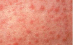 Measles